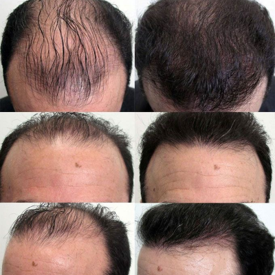 Lý do nam giới bị rụng tóc