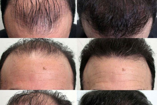 Lý do nam giới bị rụng tóc