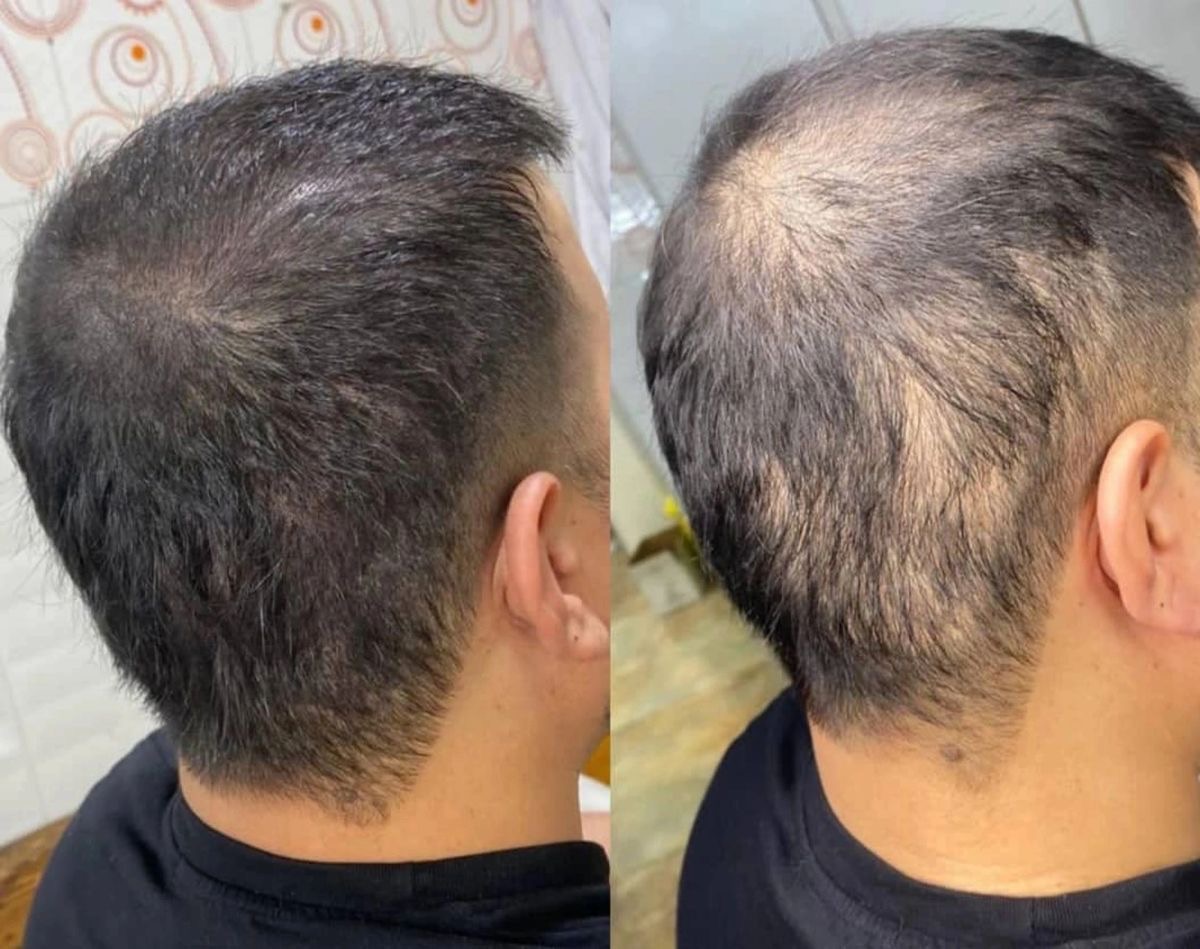 Rụng tóc ở nam giới
